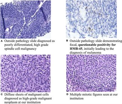 Case Report: An exceptional response to neoadjuvant radiotherapy and chemotherapy in undifferentiated pleomorphic sarcoma following checkpoint inhibitor use